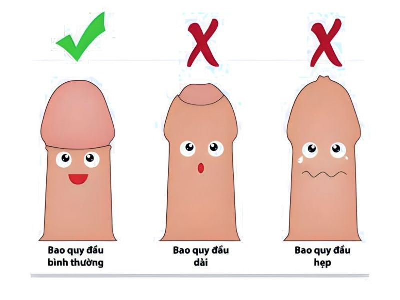 Trường hợp nào nên cắt bao quy đầu